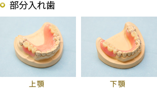 レジン床義歯　保険適応