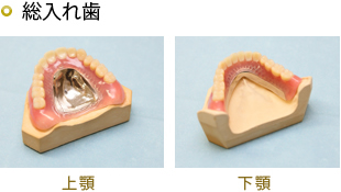 金属床義歯　　自費診療