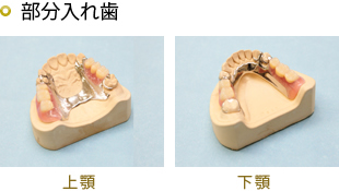 金属床義歯　　自費診療